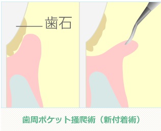 歯周ポケット掻爬術（新付着術）のイメージ写真