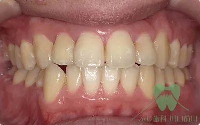 デュアルホワイトニングの症例7の術前の写真